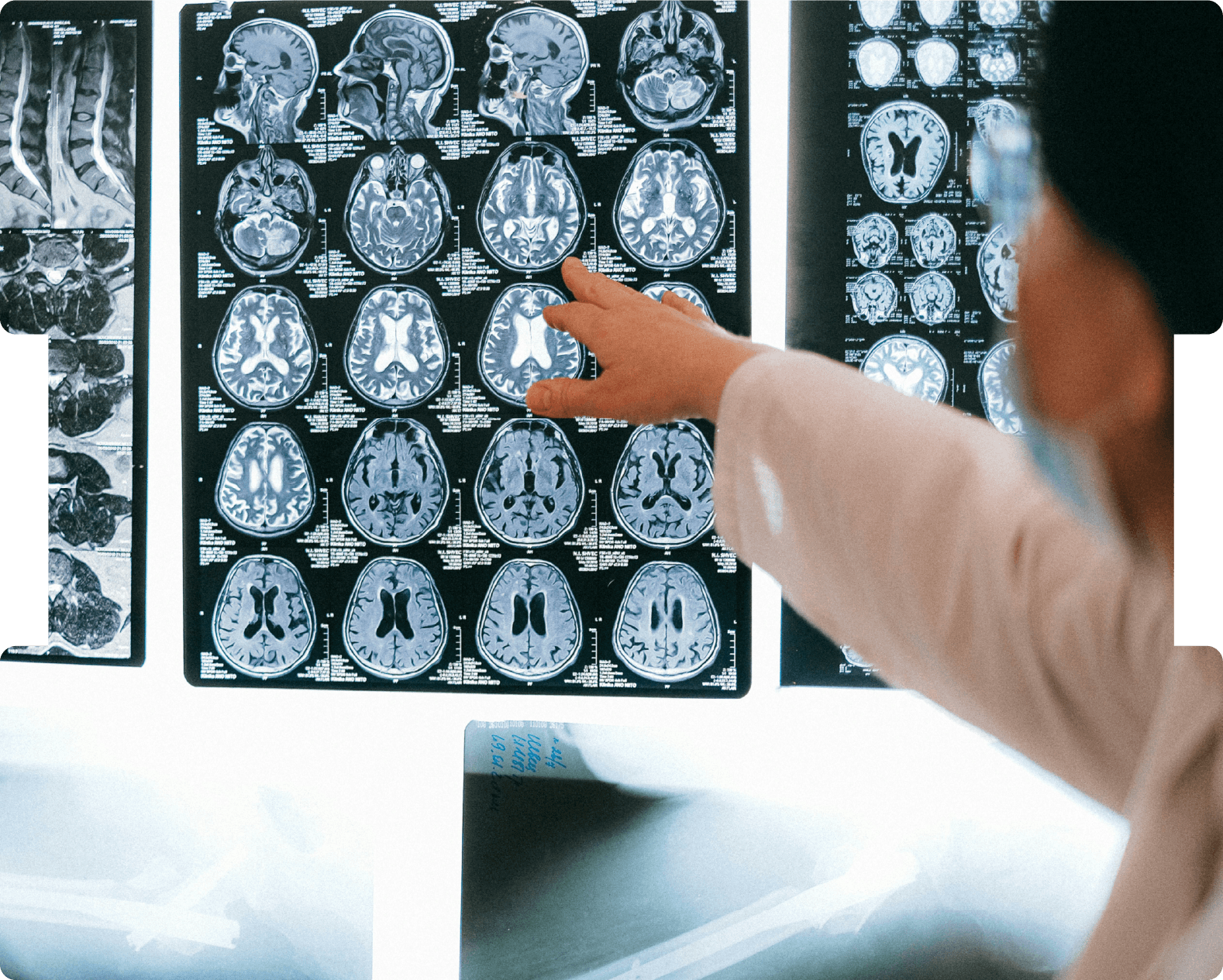 Doctor reviewing brain and spinal MRI scans displayed on a lightbox, pointing towards specific areas for analysis.