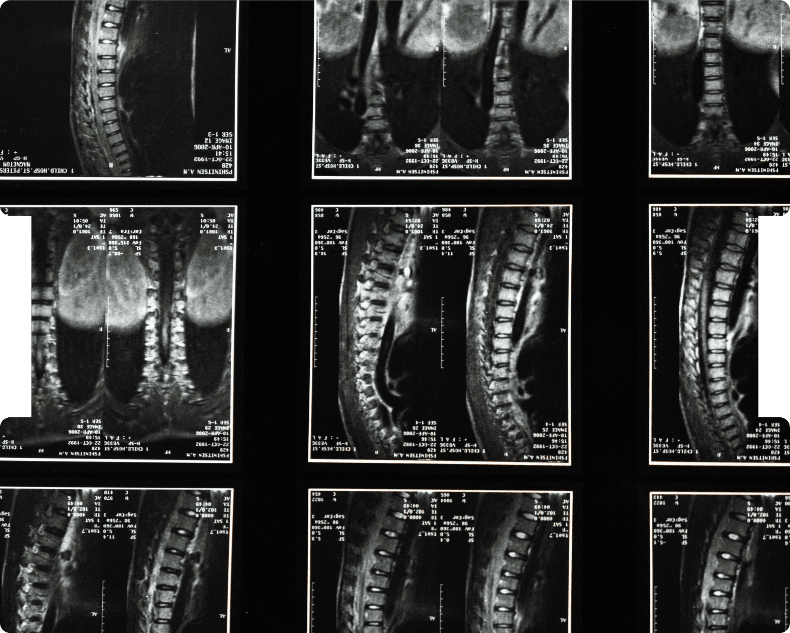 INNEG-neuro-spinal-injury